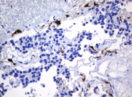 HOXD10 Antibody - IHC of paraffin-embedded Carcinoma of Human pancreas tissue using anti-HOXD10 mouse monoclonal antibody. (Heat-induced epitope retrieval by 10mM citric buffer, pH6.0, 120°C for 3min).