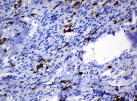 HOXD10 Antibody - IHC of paraffin-embedded Carcinoma of Human thyroid tissue using anti-HOXD10 mouse monoclonal antibody. (Heat-induced epitope retrieval by 10mM citric buffer, pH6.0, 120°C for 3min).