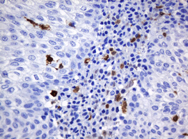 HOXD10 Antibody - IHC of paraffin-embedded Carcinoma of Human bladder tissue using anti-HOXD10 mouse monoclonal antibody. (Heat-induced epitope retrieval by 10mM citric buffer, pH6.0, 120°C for 3min).