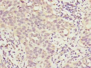 HOXD10 Antibody - Immunohistochemistry of paraffin-embedded human bladder cancer at dilution 1:100