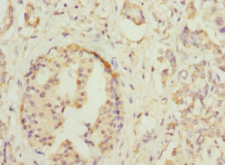 HOXD10 Antibody - Immunohistochemistry of paraffin-embedded human pancreatic cancer at dilution 1:100