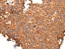 HOXD8 Antibody - Immunohistochemistry of paraffin-embedded Human ovarian cancer tissue  using HOXD8 Polyclonal Antibody at dilution of 1:40(×200)