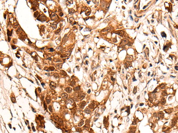 HOXD8 Antibody - Immunohistochemistry of paraffin-embedded Human gastric cancer tissue  using HOXD8 Polyclonal Antibody at dilution of 1:40(×200)