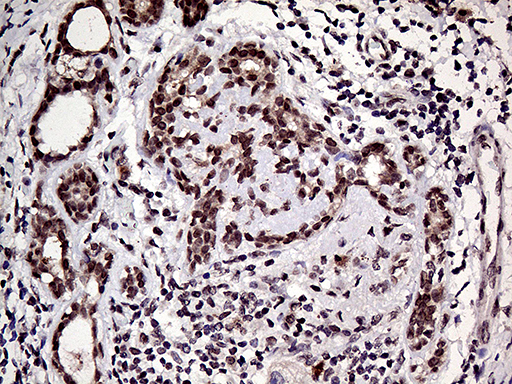 HOXD9 Antibody - Immunohistochemical staining of paraffin-embedded Human breast tissue within the normal limits using anti-HOXD9 mouse monoclonal antibody. (Heat-induced epitope retrieval by 1mM EDTA in 10mM Tris buffer. (pH8.5) at 120°C for 3 min. (1:150)