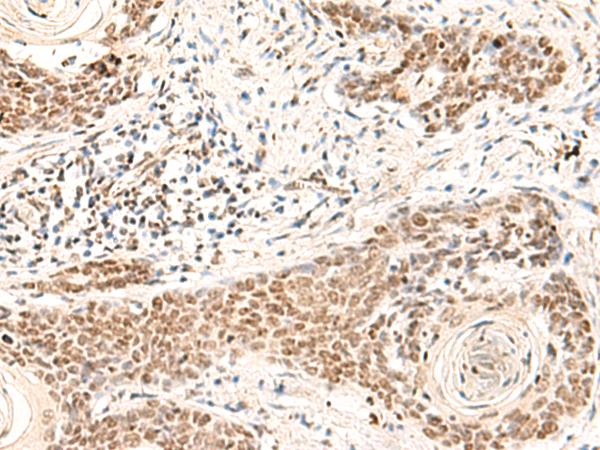 HOXD9 Antibody - Immunohistochemistry of paraffin-embedded Human esophagus cancer tissue  using HOXD9 Polyclonal Antibody at dilution of 1:30(×200)