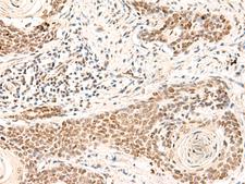 HOXD9 Antibody - Immunohistochemistry of paraffin-embedded Human esophagus cancer tissue  using HOXD9 Polyclonal Antibody at dilution of 1:30(×200)