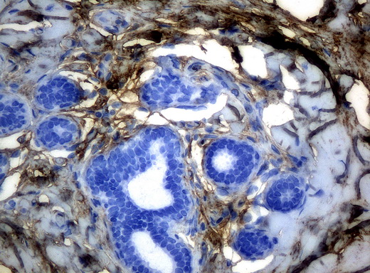 HP / Haptoglobin Antibody - Immunohistochemical staining of paraffin-embedded breast tissue using anti-HP mouse monoclonal antibody. (Clone UMAB10, dilution 1:100; heat-induced epitope retrieval by 10mM citric buffer, pH6.0, 120C for 3min)