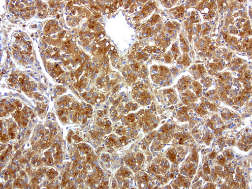HP / Haptoglobin Antibody - Immunohistochemical staining of paraffin-embedded human liver cancer using anti-HP clone UMAB10 mouse monoclonal antibody at 1:200 dilution of 1.0 mg/mL using Polink2 Broad HRP DAB for detection.requires HIER with with citrate pH6.0 at 110C for 3 min using pressure chamber/cooker. The tumor cells shows membrane and cytoplasmic staining.