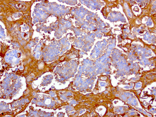 HP / Haptoglobin Antibody - Immunohistochemical staining of paraffin-embedded human ovarian cancer using anti-HP clone UMAB10 mouse monoclonal antibody at 1:200 dilution of 1.0 mg/mL using Polink2 Broad HRP DAB for detection.requires HIER with with citrate pH6.0 at 110C for 3 min using pressure chamber/cooker. The tumor cells shows membrane and cytoplasmic staining.