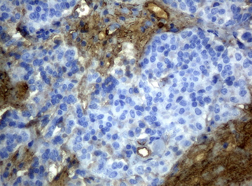 HP / Haptoglobin Antibody - Immunohistochemical staining of paraffin-embedded Carcinoma of pancreas tissue using anti-HPmouse monoclonal antibody. (Clone UMAB10, dilution 1:100; heat-induced epitope retrieval by 10mM citric buffer, pH6.0, 120C for 3min)