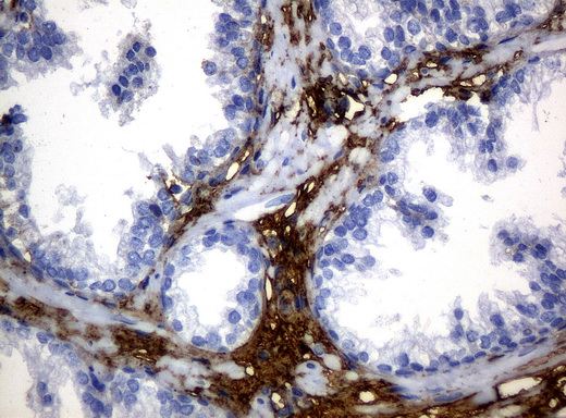 HP / Haptoglobin Antibody - Immunohistochemical staining of paraffin-embedded prostate tissue using anti-HPmouse monoclonal antibody. (Clone UMAB10, dilution 1:100; heat-induced epitope retrieval by 10mM citric buffer, pH6.0, 120C for 3min)