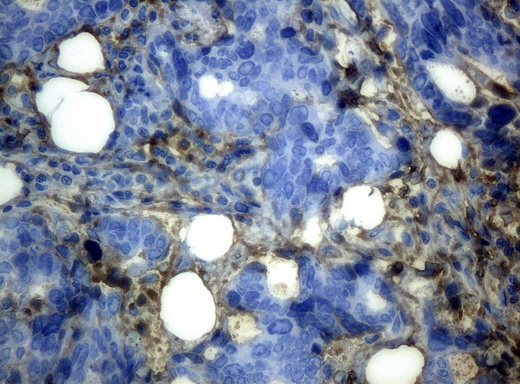 HP / Haptoglobin Antibody - Immunohistochemical staining of paraffin-embedded Adenocarcinoma of breast tissue using anti-HP mouse monoclonal antibody. (Clone UMAB10, dilution 1:100; heat-induced epitope retrieval by 10mM citric buffer, pH6.0, 120C for 3min)