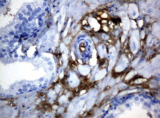 HP / Haptoglobin Antibody - Immunohistochemical staining of paraffin-embedded Carcinoma of prostate tissue using anti-HPmouse monoclonal antibody. (Clone UMAB10, dilution 1:100; heat-induced epitope retrieval by 10mM citric buffer, pH6.0, 120C for 3min)