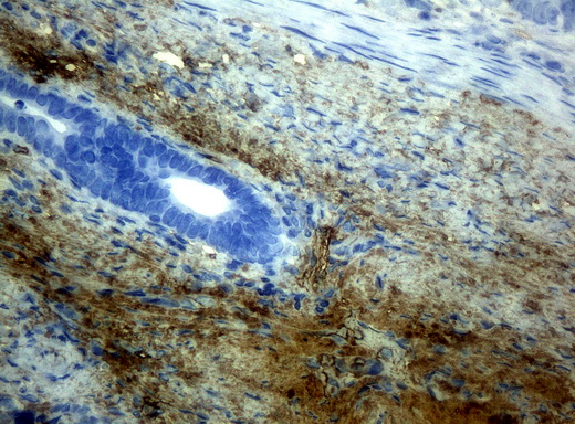 HP / Haptoglobin Antibody - Immunohistochemical staining of paraffin-embedded Adenocarcinoma of colon tissue using anti-HPmouse monoclonal antibody. (Clone UMAB10, dilution 1:100; heat-induced epitope retrieval by 10mM citric buffer, pH6.0, 120C for 3min)