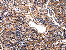 HP / Haptoglobin Antibody - Immunohistochemistry of paraffin-embedded Human lung cancer using HP Polyclonal Antibody at dilution of 1:25.
