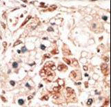 HPCA / Hippocalcin Antibody - Formalin-fixed and paraffin-embedded human cancer tissue reacted with the primary antibody, which was peroxidase-conjugated to the secondary antibody, followed by DAB staining. This data demonstrates the use of this antibody for immunohistochemistry; clinical relevance has not been evaluated. BC = breast carcinoma; HC = hepatocarcinoma.