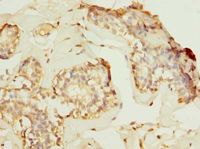 HPCAL1 / Hippocalcin-Like 1 Antibody - Immunohistochemistry of paraffin-embedded human breast cancer using antibody at dilution of 1:100.