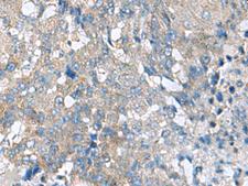 HPCAL1 / Hippocalcin-Like 1 Antibody - Immunohistochemistry of paraffin-embedded Human liver cancer tissue  using HPCAL1 Polyclonal Antibody at dilution of 1:70(×200)