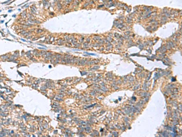 HPCAL1 / Hippocalcin-Like 1 Antibody - Immunohistochemistry of paraffin-embedded Human colorectal cancer tissue  using HPCAL1 Polyclonal Antibody at dilution of 1:70(×200)