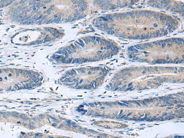 HPCAL1 / Hippocalcin-Like 1 Antibody - Immunohistochemistry of paraffin-embedded Human colorectal cancer tissue  using HPCAL1 Polyclonal Antibody at dilution of 1:90(×200)