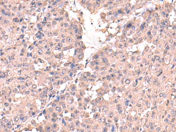 HPN / TMPRSS1 / Hepsin Antibody - Immunohistochemistry of paraffin-embedded Human liver cancer tissue  using HPN Polyclonal Antibody at dilution of 1:50(×200)