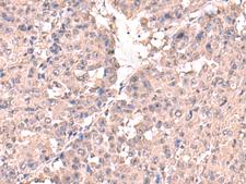 HPN / TMPRSS1 / Hepsin Antibody - Immunohistochemistry of paraffin-embedded Human liver cancer tissue  using HPN Polyclonal Antibody at dilution of 1:50(×200)