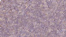 HPS5 Antibody - 1:100 staining human lymph carcinoma tissue by IHC-P. The sample was formaldehyde fixed and a heat mediated antigen retrieval step in citrate buffer was performed. The sample was then blocked and incubated with the antibody for 1.5 hours at 22°C. An HRP conjugated goat anti-rabbit antibody was used as the secondary.