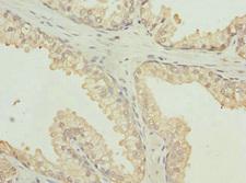 HPTPB / PTPRB Antibody - Immunohistochemistry of paraffin-embedded human prostata cancer at dilution 1:100
