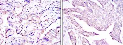 HPV11 E7 Antibody - IHC of paraffin-embedded placenta tissues (left) and ovarian cancer (right) using E7 mouse monoclonal antibody with DAB staining.