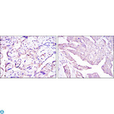 HPV11 E7 Antibody - Immunohistochemistry (IHC) analysis of paraffin-embedded placenta tissues (left) and ovarian cancer (right) with DAB staining using E7 Monoclonal Antibody.