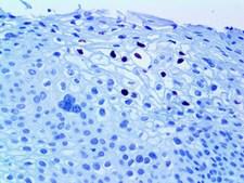 HPV16 L1 Antibody - IHC of HPV16 on an FFPE Infected Cervix Tissue