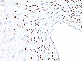 HPV16 L1 Antibody - Formalin-fixed, paraffin-embedded human cervix stained with HPV-16 L1 antibody (HPV16L1/1058).  This image was taken for the unmodified form of this product. Other forms have not been tested.