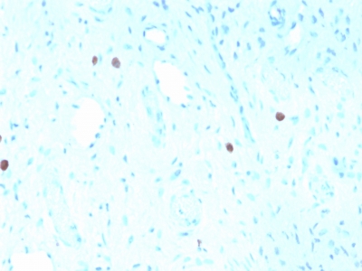 HPV16 L1 Antibody - Formalin-fixed, paraffin-embedded human Cervix stained with HPV-16 Mouse Recombinant Monoclonal Antibody (rHPV16L1/1058).