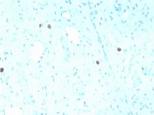 HPV16 L1 Antibody - Formalin-fixed, paraffin-embedded human Cervix stained with HPV-16 Mouse Recombinant Monoclonal Antibody (rHPV16L1/1058).