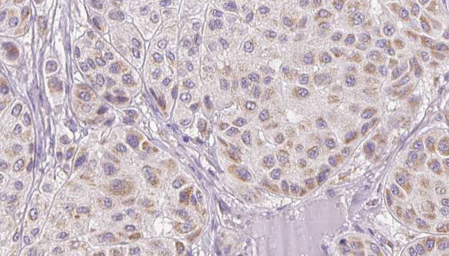 HPX / Hemopexin Antibody - 1:100 staining human Melanoma tissue by IHC-P. The sample was formaldehyde fixed and a heat mediated antigen retrieval step in citrate buffer was performed. The sample was then blocked and incubated with the antibody for 1.5 hours at 22°C. An HRP conjugated goat anti-rabbit antibody was used as the secondary.