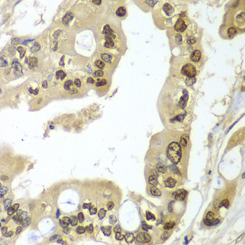 HR6B / UBE2B Antibody - Immunohistochemistry of paraffin-embedded human liver cancer tissue.