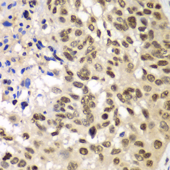 HR6B / UBE2B Antibody - Immunohistochemistry of paraffin-embedded human esophageal cancer tissue.