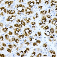 HRAS / H-Ras Antibody - Immunohistochemical analysis of H-Ras staining in human gastric cancer formalin fixed paraffin embedded tissue section. The section was pre-treated using heat mediated antigen retrieval with sodium citrate buffer (pH 6.0). The section was then incubated with the antibody at room temperature and detected using an HRP conjugated compact polymer system. DAB was used as the chromogen. The section was then counterstained with hematoxylin and mounted with DPX.