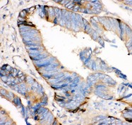 HRG Antibody - HRG antibody IHC-paraffin: Human Intestinal Cancer Tissue.