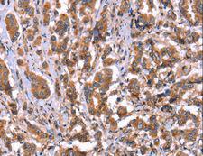 HRG Antibody - Immunohistochemistry of paraffin-embedded Human ovarian cancer using HRG Polyclonal Antibody at dilution of 1:50.