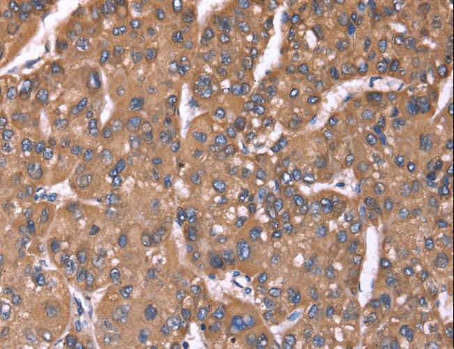 HRG Antibody - Immunohistochemistry of paraffin-embedded Human liver cancer using HRG Polyclonal Antibody at dilution of 1:50.