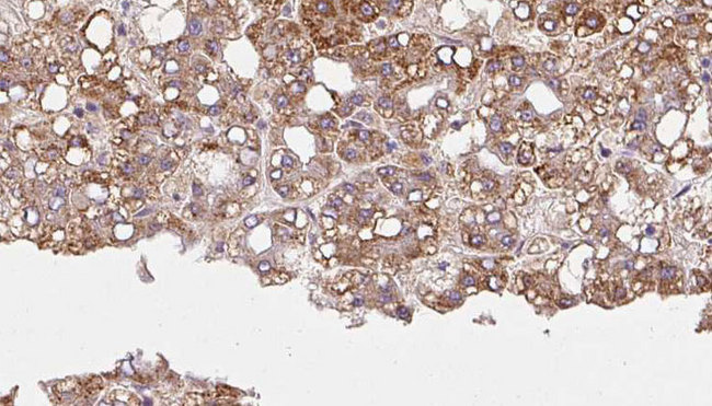HRH4 / Histamine H4 Receptor Antibody - 1:100 staining human liver carcinoma tissues by IHC-P. The sample was formaldehyde fixed and a heat mediated antigen retrieval step in citrate buffer was performed. The sample was then blocked and incubated with the antibody for 1.5 hours at 22°C. An HRP conjugated goat anti-rabbit antibody was used as the secondary.