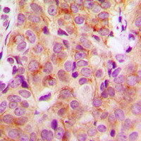HRS / HGS Antibody - Immunohistochemical analysis of HGS staining in human breast cancer formalin fixed paraffin embedded tissue section. The section was pre-treated using heat mediated antigen retrieval with sodium citrate buffer (pH 6.0). The section was then incubated with the antibody at room temperature and detected using an HRP conjugated compact polymer system. DAB was used as the chromogen. The section was then counterstained with hematoxylin and mounted with DPX.