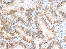 HRSP12 / UK114 Antibody - Immunohistochemistry of paraffin-embedded Human lung cancer tissue  using RIDA Polyclonal Antibody at dilution of 1:65(×200)