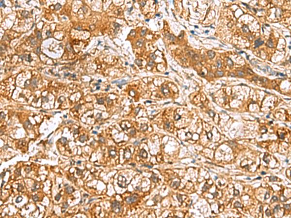 HRSP12 / UK114 Antibody - Immunohistochemistry of paraffin-embedded Human liver cancer tissue  using RIDA Polyclonal Antibody at dilution of 1:65(×200)