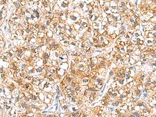 HRSP12 / UK114 Antibody - Immunohistochemistry of paraffin-embedded Human liver cancer tissue  using RIDA Polyclonal Antibody at dilution of 1:70(×200)