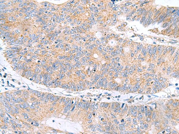 HRSP12 / UK114 Antibody - Immunohistochemistry of paraffin-embedded Human colorectal cancer tissue  using RIDA Polyclonal Antibody at dilution of 1:70(×200)
