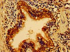 HS2ST1 Antibody - Immunohistochemistry of paraffin-embedded human lung cancer using HS2ST1 Antibody at dilution of 1:100