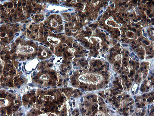 HSCB Antibody - IHC of paraffin-embedded Carcinoma of Human thyroid tissue using anti-HSCB mouse monoclonal antibody. (Heat-induced epitope retrieval by 1 mM EDTA in 10mM Tris, pH8.5, 120°C for 3min).
