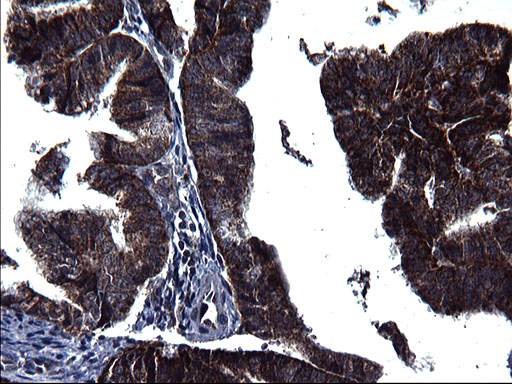 HSCB Antibody - IHC of paraffin-embedded Adenocarcinoma of Human endometrium tissue using anti-HSCB mouse monoclonal antibody. (Heat-induced epitope retrieval by 1 mM EDTA in 10mM Tris, pH8.5, 120°C for 3min).